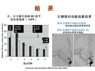 结  果 开始动脉内给药 停止动脉内给药 栓塞 右侧 左侧 Cardiovasc Intervent Radiol.  2008 Nov-Dec;31(6):1200-4. 图 A. 尼莫地平动脉内注射前： 颈动脉远端血管重度痉挛 图 B. 尼莫地平动脉内注射后 1h: 痉挛的血管管径增加 右侧颈内动脉造影结果 左、右大脑中动脉 M1 段平均血流速度（ mFV ） 
