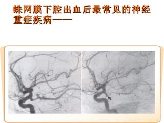 蛛网膜下腔出血后最常见的神经重症疾病—— 难治性脑血管痉挛 