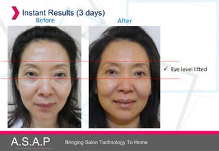 Instant Results (3 days)
                           Before                                          After




                                                                                           Eye level lifted




A.S.A.P
Accelerated Skin Augmentation and Perfection System
                                                      Bringing Salon Technology To Home
 