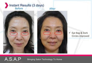 Instant Results (3 days)
                           Before                                          After




                                                                                           Eye Bag & Dark
                                                                                            Circles improved




A.S.A.P
Accelerated Skin Augmentation and Perfection System
                                                      Bringing Salon Technology To Home
 