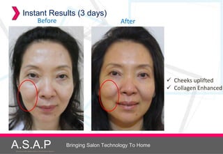 Instant Results (3 days)
                            Before                                         After




                                                                                           Cheeks uplifted
                                                                                           Collagen Enhanced




A.S.A.P
Accelerated Skin Augmentation and Perfection System
                                                      Bringing Salon Technology To Home
 