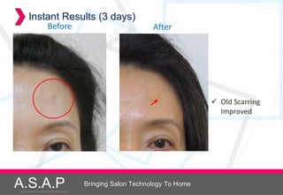 Instant Results (3 days)
                            Before                                         After




                                                                                           Old Scarring
                                                                                            Improved




A.S.A.P
Accelerated Skin Augmentation and Perfection System
                                                      Bringing Salon Technology To Home
 