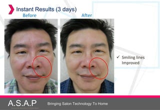 Instant Results (3 days)
                    Before                                              After




                                                                                           Smiling lines
                                                                                            Improved




A.S.A.P
Accelerated Skin Augmentation and Perfection System
                                                      Bringing Salon Technology To Home
 