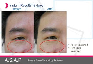 Instant Results (3 days)
                    Before                                              After




                                                                                           Pores Tightened
                                                                                           Fine lines
                                                                                            Improved


A.S.A.P
Accelerated Skin Augmentation and Perfection System
                                                      Bringing Salon Technology To Home
 