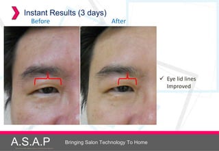 Instant Results (3 days)
                    Before                                              After




                                                                                           Eye lid lines
                                                                                            Improved




A.S.A.P
Accelerated Skin Augmentation and Perfection System
                                                      Bringing Salon Technology To Home
 