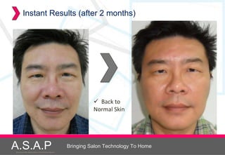Instant Results (after 2 months)




                                                                 Back to
                                                                Normal Skin




A.S.A.P
Accelerated Skin Augmentation and Perfection System
                                                      Bringing Salon Technology To Home
 
