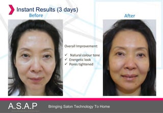 Instant Results (3 days)
                               Before                                                     After




                                                              Overall Improvement:

                                                               Natural colour tone
                                                               Energetic look
                                                               Pores tightened




A.S.A.P
Accelerated Skin Augmentation and Perfection System
                                                      Bringing Salon Technology To Home
 