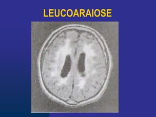 LEUCOARAIOSE
 