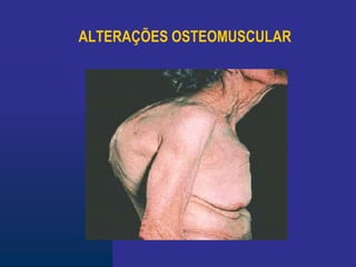 ALTERAÇÕES OSTEOMUSCULAR
 