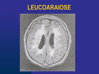 LEUCOARAIOSE
 