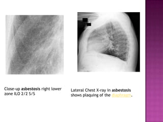 Asbestos | PPTX