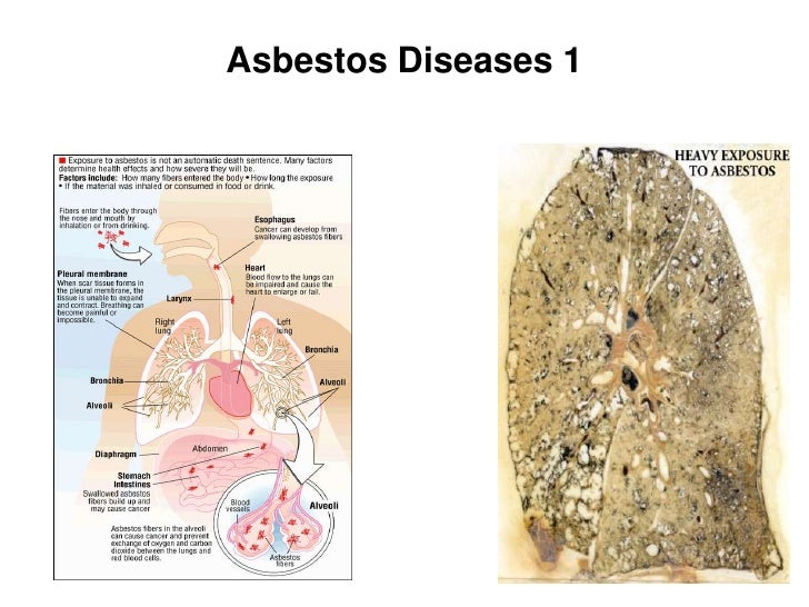 asbestosdisease