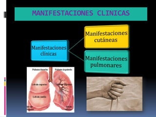 MANIFESTACIONES CLINICAS
 