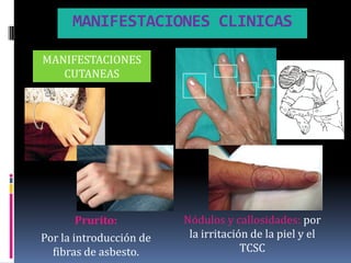 MANIFESTACIONES CLINICAS

MANIFESTACIONES
   CUTANEAS




        Prurito:         Nódulos y callosidades: por
Por la introducción de    la irritación de la piel y el
  fibras de asbesto.                  TCSC
 