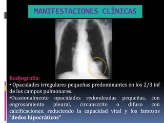 MANIFESTACIONES CLÍNICAS




Radiografía:
• Opacidades irregulares pequeñas predominantes en los 2/3 inf
de los campos pulmonares.
•Ocasionalmente opacidades redondeadas pequeñas, con
engrosamiento      pleural,  circunscrito   o   difuso    con
calcificaciones, reduciendo la capacidad vital y los famosos
“dedos hipocráticos”
 