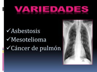 Asbestosis
Mesotelioma
Cáncer de pulmón
 