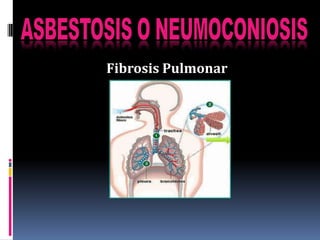 Fibrosis Pulmonar
 