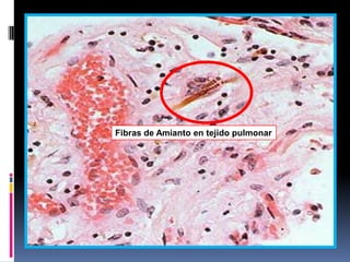 Fibras de Amianto en tejido pulmonar
 