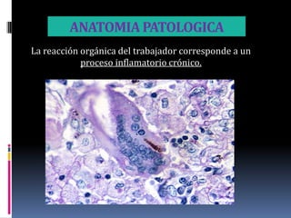 ANATOMIA PATOLOGICA
La reacción orgánica del trabajador corresponde a un
            proceso inflamatorio crónico.
 