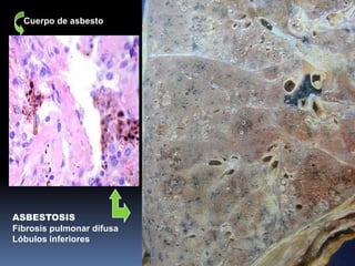 Cuerpo de asbesto




ASBESTOSIS
Fibrosis pulmonar difusa
Lóbulos inferiores
 