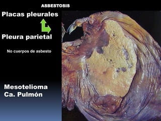 ASBESTOSIS

Placas pleurales


Pleura parietal

 No cuerpos de asbesto




Mesotelioma
Ca. Pulmón
 