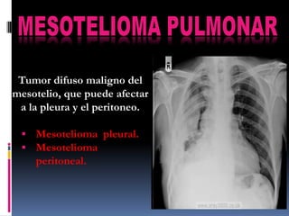 Tumor difuso maligno del
mesotelio, que puede afectar
 a la pleura y el peritoneo.

  Mesotelioma pleural.
  Mesotelioma
    peritoneal.
 