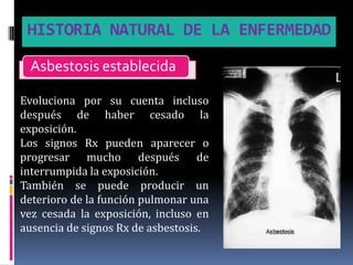 HISTORIA NATURAL DE LA ENFERMEDAD

 Asbestosis establecida

Evoluciona por su cuenta incluso
después de haber cesado la
exposición.
Los signos Rx pueden aparecer o
progresar mucho después de
interrumpida la exposición.
También se puede producir un
deterioro de la función pulmonar una
vez cesada la exposición, incluso en
ausencia de signos Rx de asbestosis.
 
