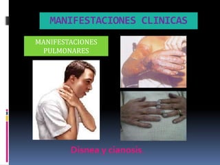 MANIFESTACIONES CLINICAS
MANIFESTACIONES
  PULMONARES




        Disnea y cianosis.
 
