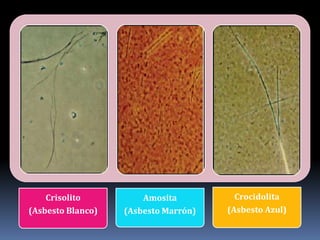 Crisolito          Amosita          Crocidolita
(Asbesto Blanco)   (Asbesto Marrón)   (Asbesto Azul)
 