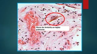Fibras de Amianto en tejido
pulmonar
 
