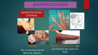 MANIFESTACIONES
CLINICAS
Prurito:
Por la introducción de
fibras de asbesto.
MANIFESTACIONES
CUTANEAS
Nódulos y callosidades: por
la irritación de la piel y el
TCSC
 