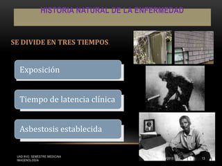 HISTORIA NATURAL DE LA ENFERMEDAD
Exposición
Tiempo de latencia clínica
Asbestosis establecida
SE DIVIDE EN TRES TIEMPOS.
UAD 8VO. SEMESTRE MEDICINA
IMAGENOLOGÍA
15/05/2015 13
 