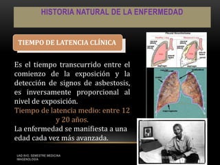 HISTORIA NATURAL DE LA ENFERMEDAD
TIEMPO DE LATENCIA CLÍNICA
Es el tiempo transcurrido entre el
comienzo de la exposición y la
detección de signos de asbestosis,
es inversamente proporcional al
nivel de exposición.
Tiempo de latencia medio: entre 12
y 20 años.
La enfermedad se manifiesta a una
edad cada vez más avanzada.
UAD 8VO. SEMESTRE MEDICINA
IMAGENOLOGÍA
15/05/2015 14
 