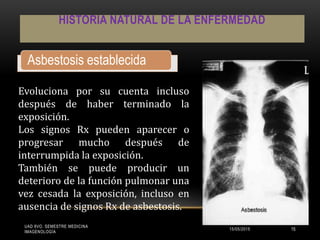 HISTORIA NATURAL DE LA ENFERMEDAD
Asbestosis establecida
Evoluciona por su cuenta incluso
después de haber terminado la
exposición.
Los signos Rx pueden aparecer o
progresar mucho después de
interrumpida la exposición.
También se puede producir un
deterioro de la función pulmonar una
vez cesada la exposición, incluso en
ausencia de signos Rx de asbestosis.
UAD 8VO. SEMESTRE MEDICINA
IMAGENOLOGÍA
15/05/2015 15
 