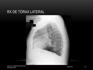 RX DE TÓRAX LATERAL
15/05/2015
UAD 8VO. SEMESTRE MEDICINA
IMAGENOLOGÍA
18
 