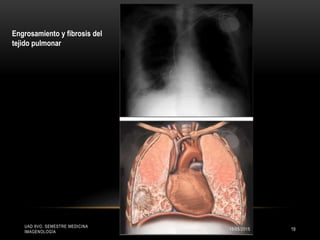 UAD 8VO. SEMESTRE MEDICINA
IMAGENOLOGÍA
Engrosamiento y fibrosis del
tejido pulmonar
15/05/2015 19
 