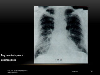 UAD 8VO. SEMESTRE MEDICINA
IMAGENOLOGÍA
Engrosamiento pleural
Calcificaciones
15/05/2015 20
 
