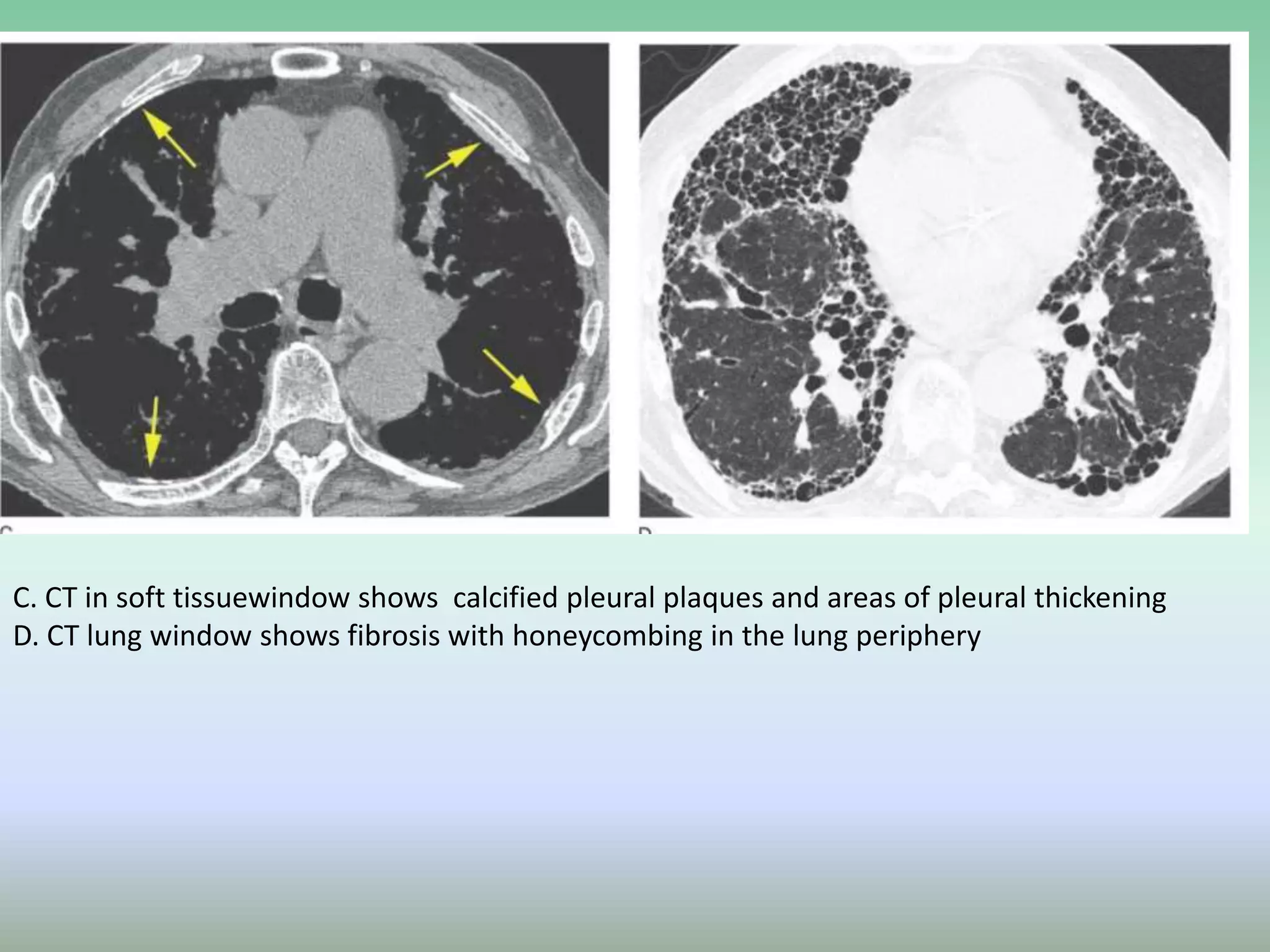 IMAGING FEATURES IN ASBESTOSIS | PPTX
