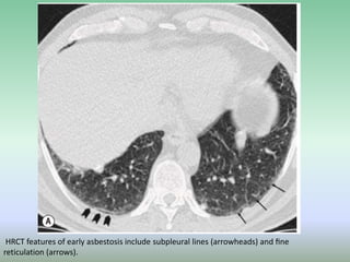 Typical Reticulation Line IMAGING FEATURES IN ASBESTOSIS | PPTX