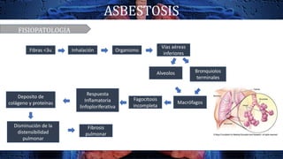 ASBESTOSIS
FISIOPATOLOGIA
Fibras <3u Inhalación Organismo
Vías aéreas
inferiores
Alveolos Bronquiolos
terminales
Macrófagos
Respuesta
Inflamatoria
linfoploriferativa
Deposito de
colágeno y proteínas
Fagocitosis
incompleta
Disminución de la
distensibilidad
pulmonar
Fibrosis
pulmonar
 