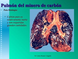 Asbestosis y Pulmon del Carbón