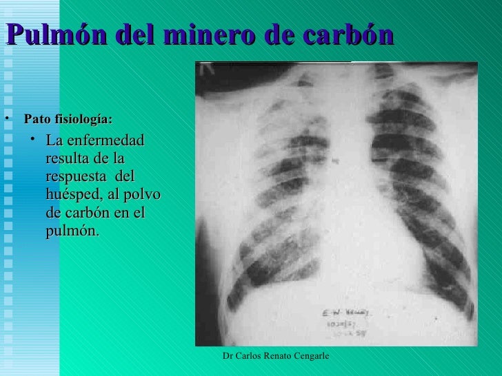 Asbestosis y Pulmon del Carbón