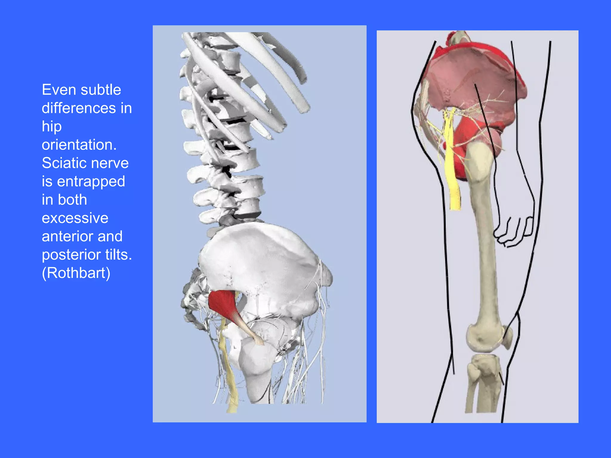 Even subtle differences in hip orientation. Sciatic nerve is entrapped in both excessive anterior and posterior tilts. (Rothbart) 