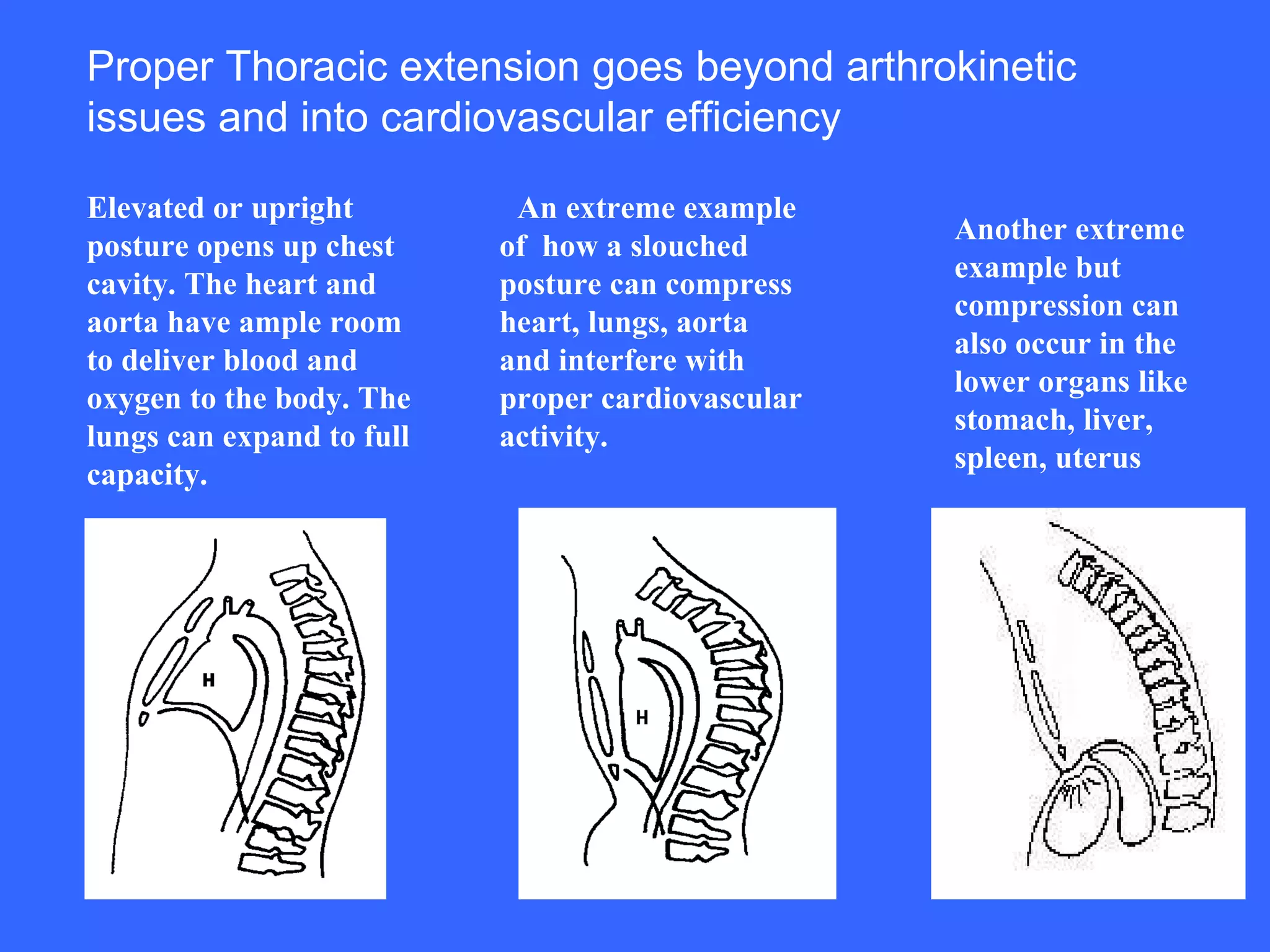 Elevated or upright posture opens up chest cavity. The heart and aorta have ample room to deliver blood and oxygen to the body. The lungs can expand to full capacity.   An extreme example of  how a slouched posture can compress heart, lungs, aorta and interfere with proper cardiovascular activity.    Another extreme example but compression can also occur in the lower organs like stomach, liver, spleen, uterus   Proper Thoracic extension goes beyond arthrokinetic issues and into cardiovascular efficiency  