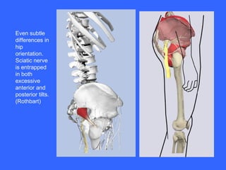 Even subtle differences in hip orientation. Sciatic nerve is entrapped in both excessive anterior and posterior tilts. (Rothbart) 