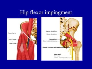 Hip flexor impingment
 