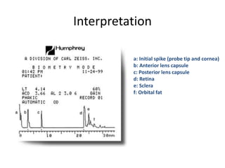 Interpretation
a: Initial spike (probe tip and cornea)
b: Anterior lens capsule
c: Posterior lens capsule
d: Retina
e: Sclera
f: Orbital fat
 