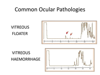 Common Ocular Pathologies
VITREOUS
FLOATER
VITREOUS
HAEMORRHAGE
 