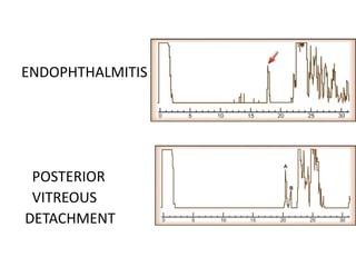 ENDOPHTHALMITIS
POSTERIOR
VITREOUS
DETACHMENT
 