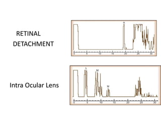 RETINAL
DETACHMENT
Intra Ocular Lens
 